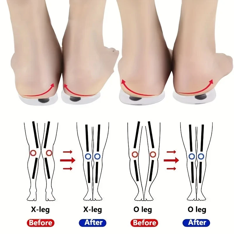 Women Shoes Types - 1 คู่ Orthopedic Insoles สําหรับฟุต O/X
