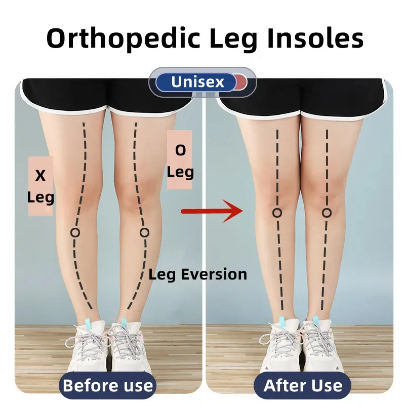 1 คู่ Orthopedic Insoles สําหร - Women Shoes Types บทวิจารณ์และราคา